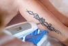 Tatoeage verwijderen