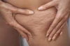 Cellulitis