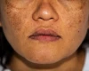 Melasma 