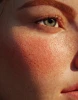Rosacea