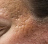 Acne littekens
