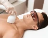 Laserontharing