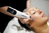 Microneedling