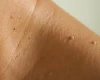 Fibromen