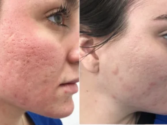 microneedling-1