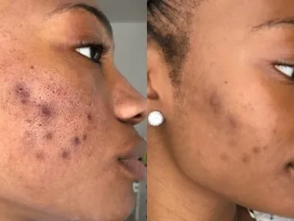 microneedling-2