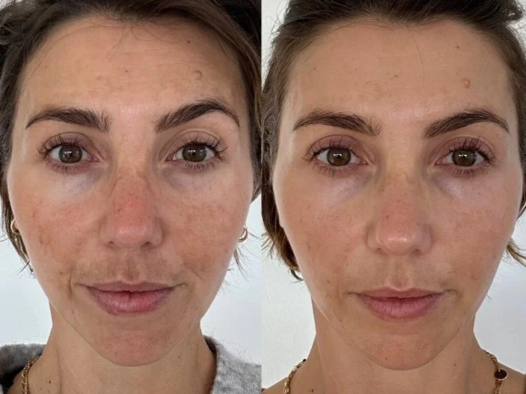 microneedling-3