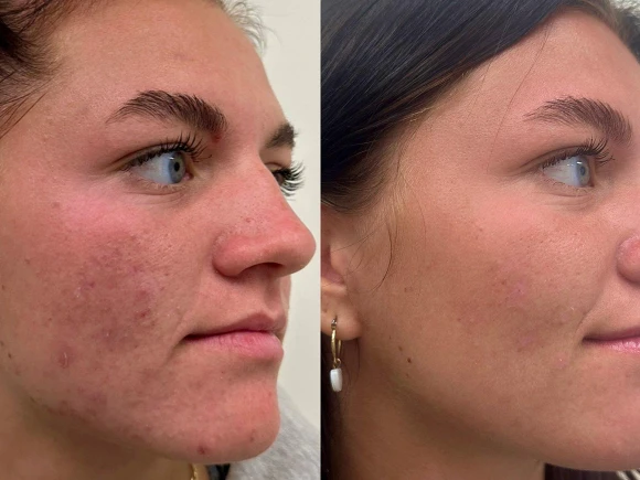 microneedling-4