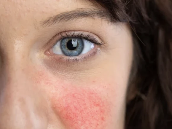 rosacea-5