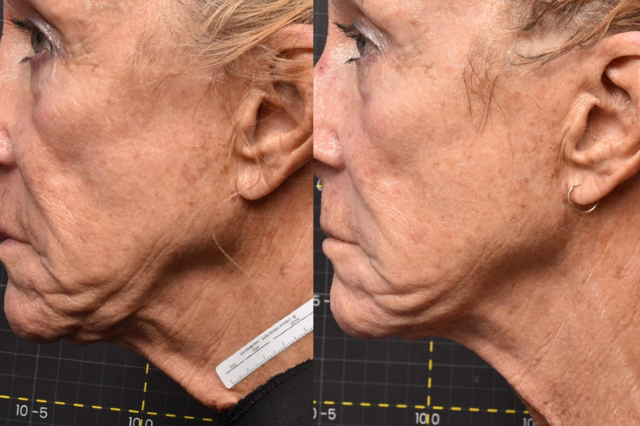 Resultaat Sofwave
