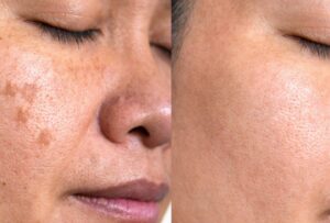 From pigmentation spots to flawless skin: how we help you cover