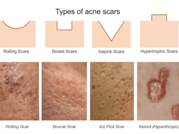 Ice-pick-acne-scar-types