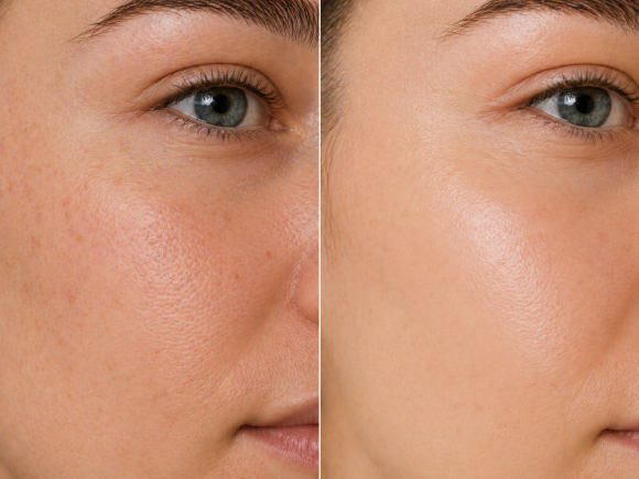 vitamine C peel voor na