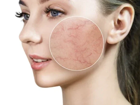 Facial-Blood-Vessels-2 (1)
