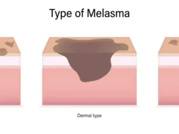 Melasma-2