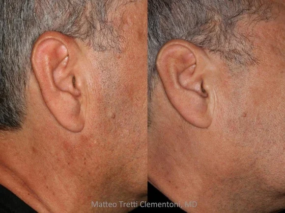 Poikiloderma-Van-Civatte-1